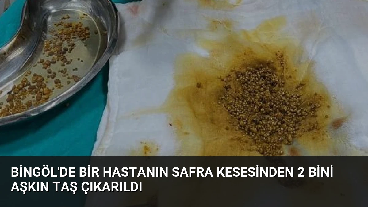 Bingöl’de Bir Hastanın Safra Kesesinden 2 Bini Aşkın Taş Çıkarıldı