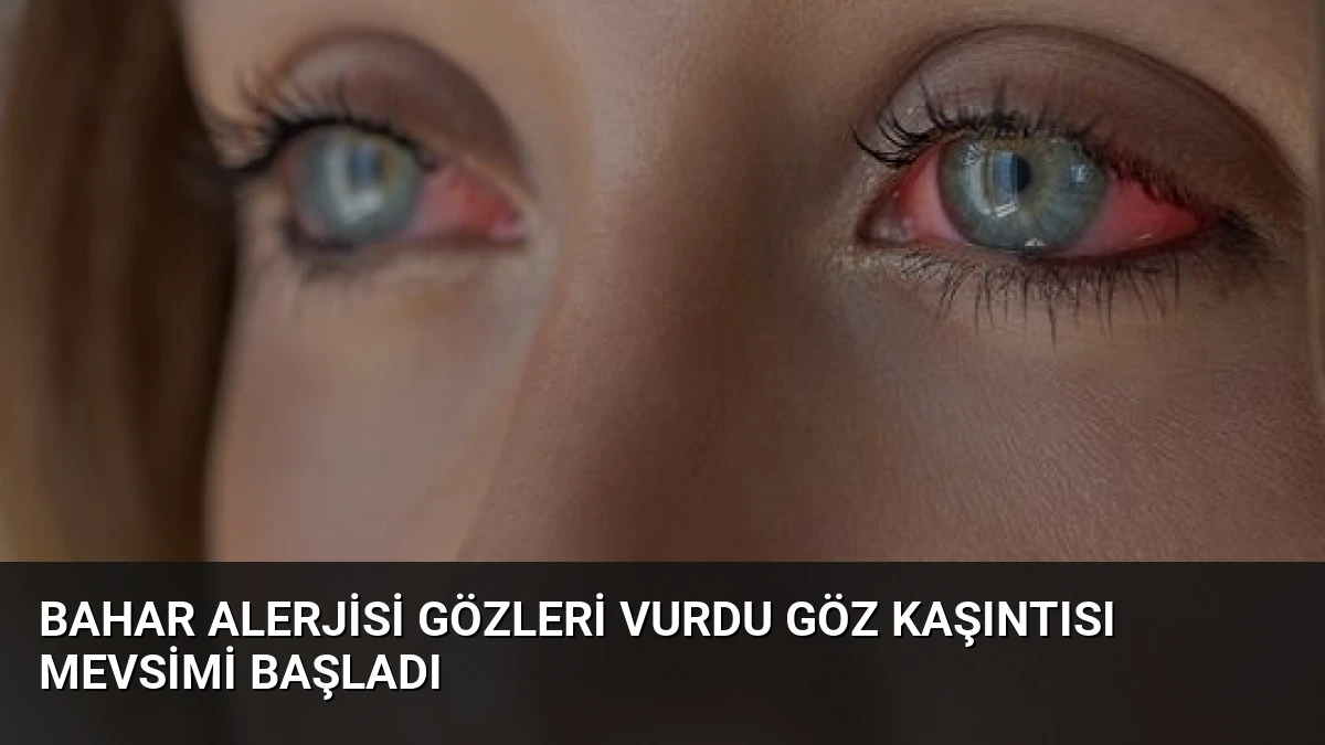 Bahar Alerjisi Gözleri Vurdu Göz Kaşıntısı Mevsimi Başladı