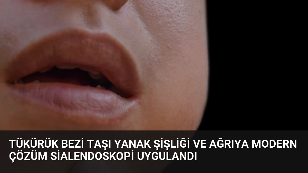 Tükürük Bezi Taşı Yanak Şişliği ve Ağrıya Modern Çözüm Sialendoskopi Uygulandı