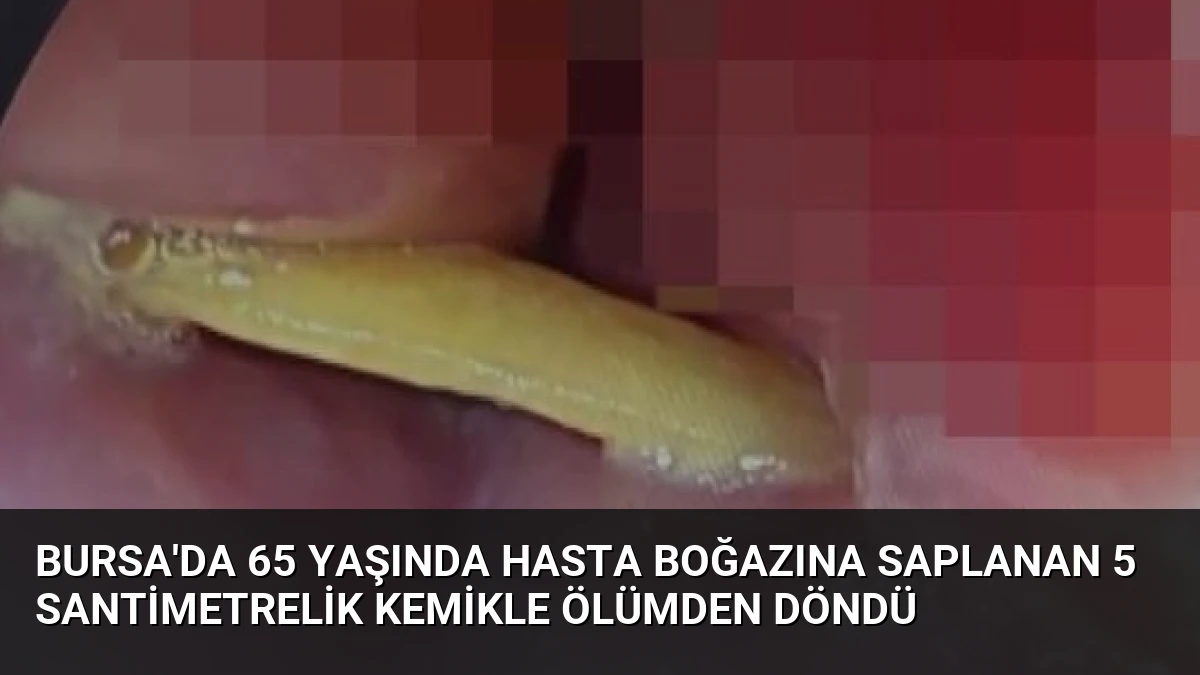 Bursa’da 65 Yaşında Hasta Boğazına Saplanan 5 Santimetrelik Kemikle Ölümden Döndü