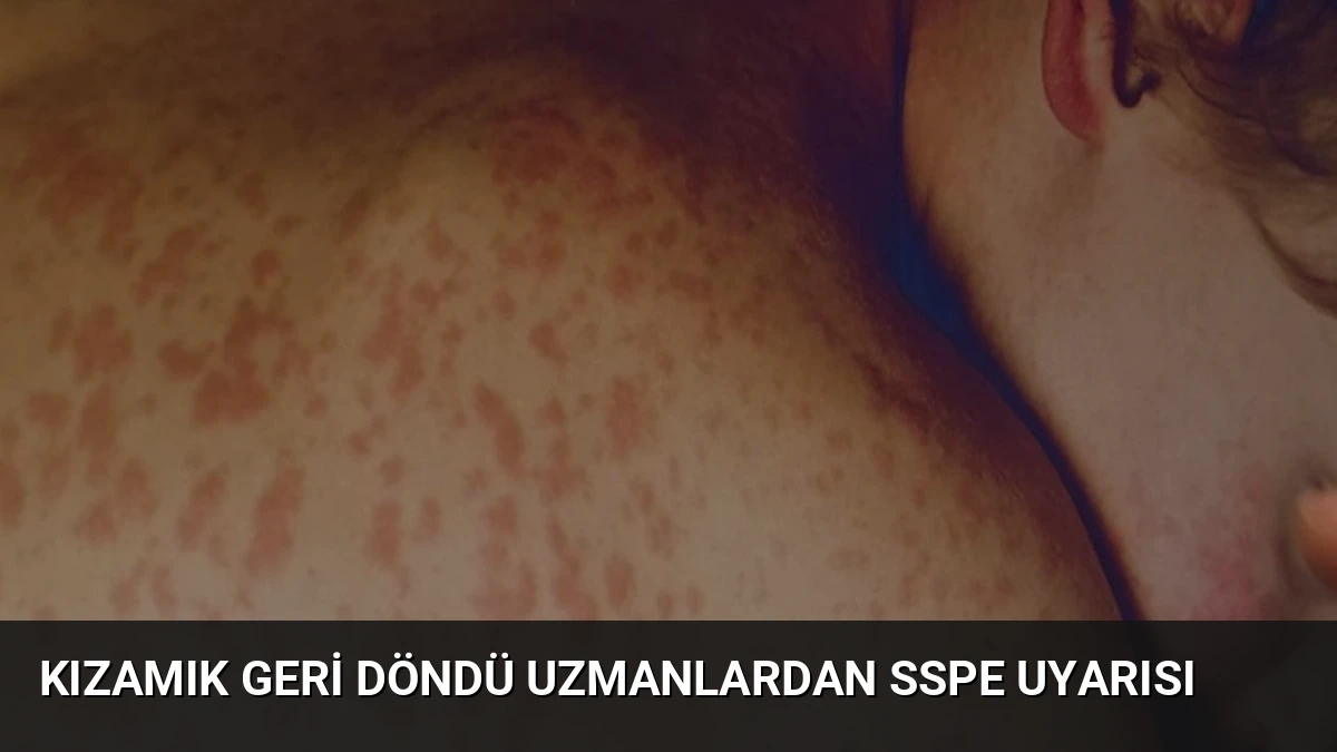 Kızamık Geri Döndü Uzmanlardan SSPE Uyarısı